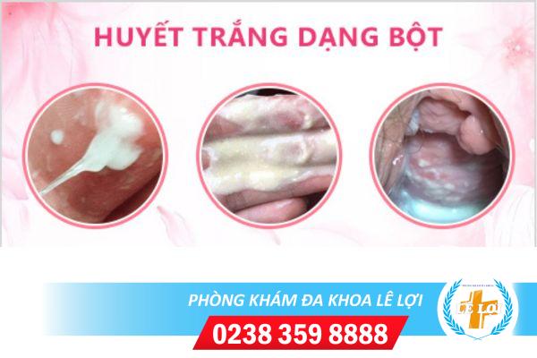 Địa chỉ điều trị huyết trắng đặc như bột hiệu quả tại Vinh