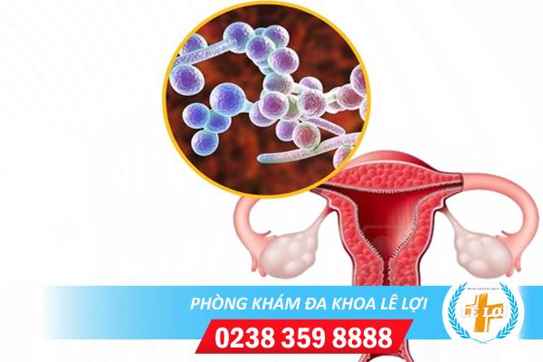 Những nguy hiểm khi bị nhiễm nấm Candida và cách chữa trị hiệu quả