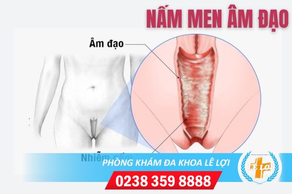 Hé lộ nguyên nhân nhiễm nấm men âm đạo kéo dài và cách trị không lo tái bệnh