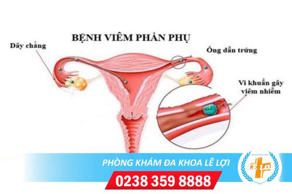 Những vị trí viêm cụ thể của viêm phần phụ