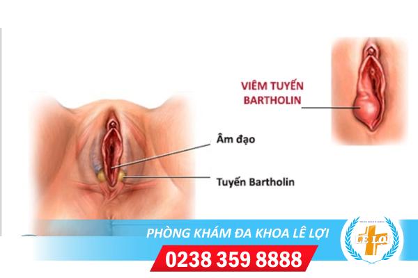 Những điều cần biết về viêm tuyến Bartholin