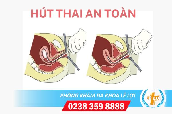 Hút phá thai nạo hút thai an toàn không?